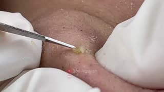 Blackheads Removal & Pimple Popper Cystic Acne Extraction #224