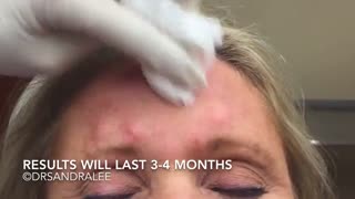 Treating frown lines glabella area
