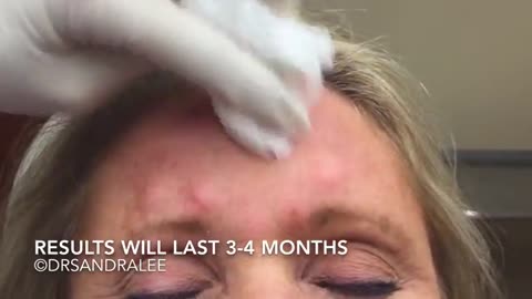 Treating frown lines glabella area