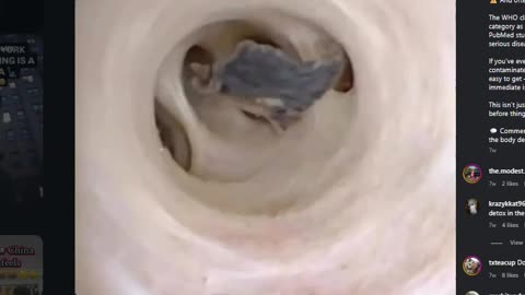 Cancer in the LIVER/GALL BLADDER? or is it Liver Flukes-Parasites!?