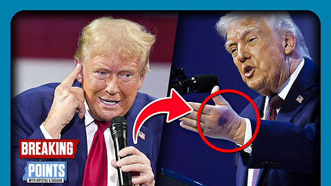 Trump FORGETS 'Alzheimers' After Bruise Incident