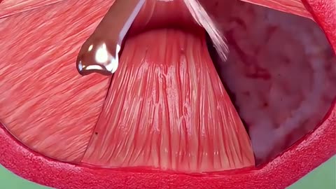 Aquablation Therapy is a modern advance treatment for enlarge Prostate