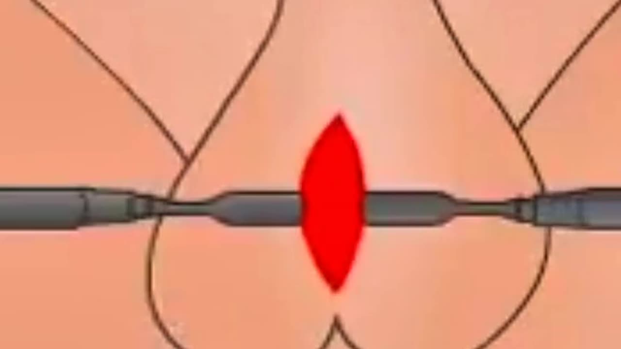 Why Would a Doctor Remove a Testicle Here’s What Orchiectomy Surgery Involves