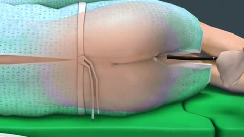 How Colonoscopy is performed