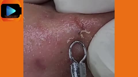 Satisfying Pimple Popping & Blackhead Extraction