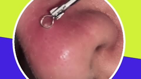 Pimple removal satisfying video (ASMR) #12 #shorts