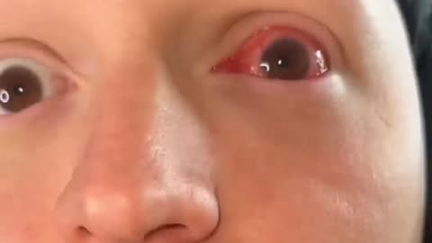 pov mom making you go to school with pink eye!!!