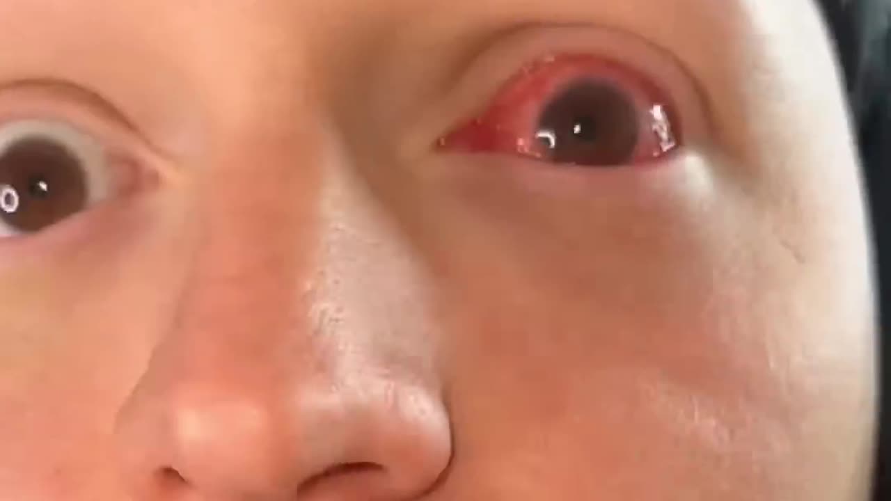 pov mom making you go to school with pink eye!!!