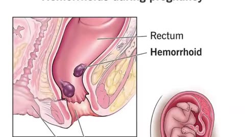 गरोदरपणात होणाऱ्या मूळव्याधींवर सुरक्षित उपाय | Piles Treatment During Pregnancy