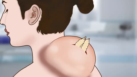 Remove cockroach from infected foot cyst animation