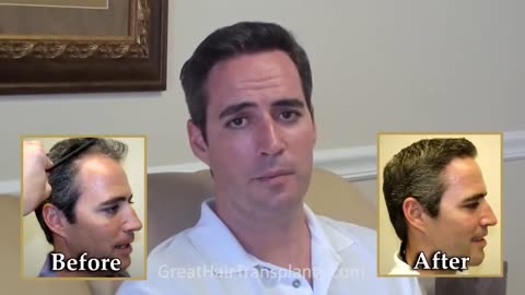 Great Hair Transplant Results Using MaxHarvest™ by Dr. Brett Bolton