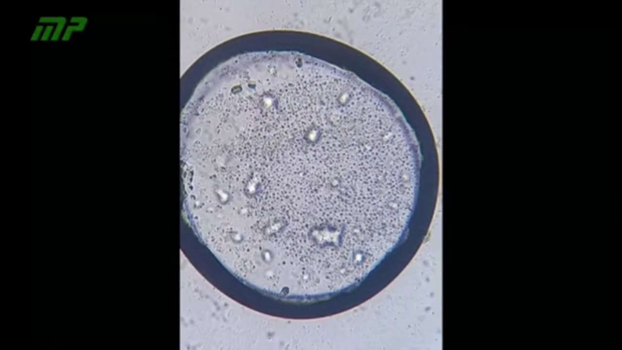 Микроскопический анализ капли ампулы витамина K ПРОВЕДЕННЫЙ ДОКТОРОМ ЛИЛИАНОЙ ЗЕЛАДОЙ