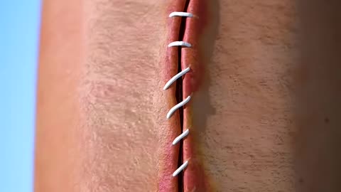 How Stitches Work 😯