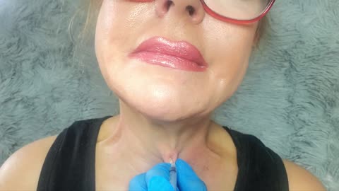 My DIY, at Home, First Time Platysmal Bands Treatment with Botox Alternative Toxin.