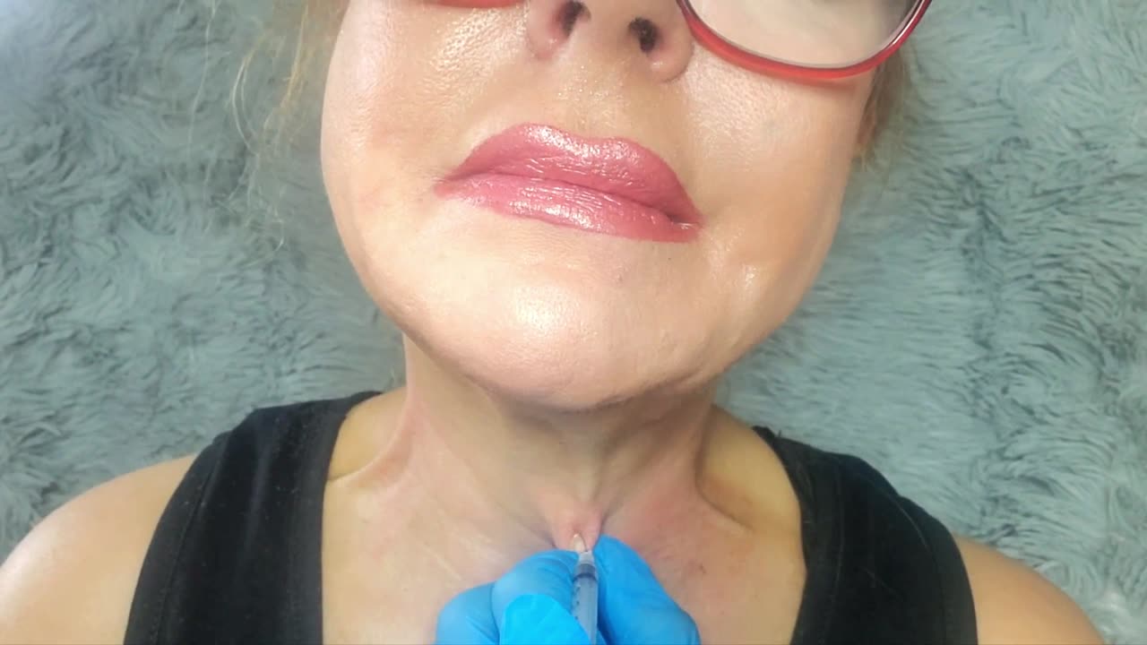 My DIY, at Home, First Time Platysmal Bands Treatment with Botox Alternative Toxin.