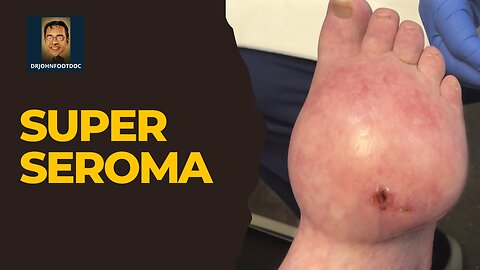 Super Seroma !