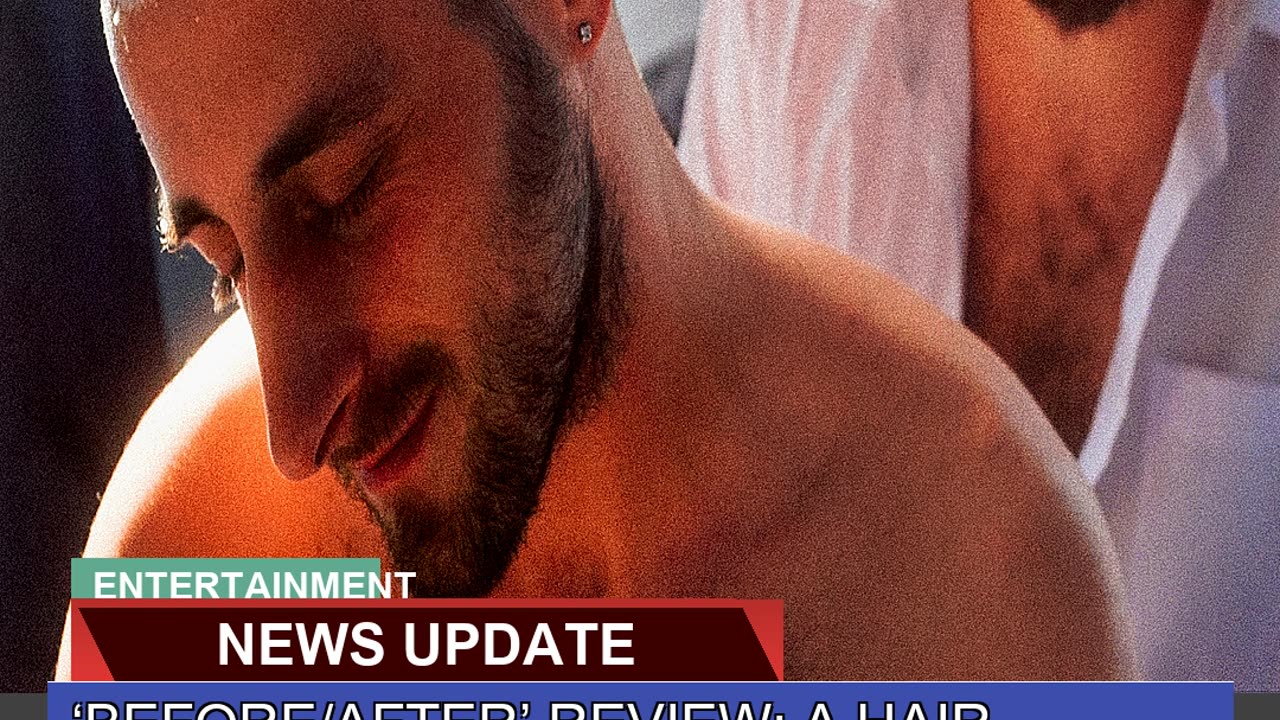 Beforeafter Review a Hair Transplant Bonds Two