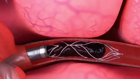 Mechanical Thrombectomy Procedure (3D Animation)