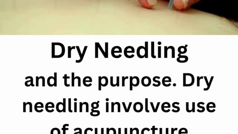 Dry Needling Treatment | Divinecare Physiotherapy Langley BC