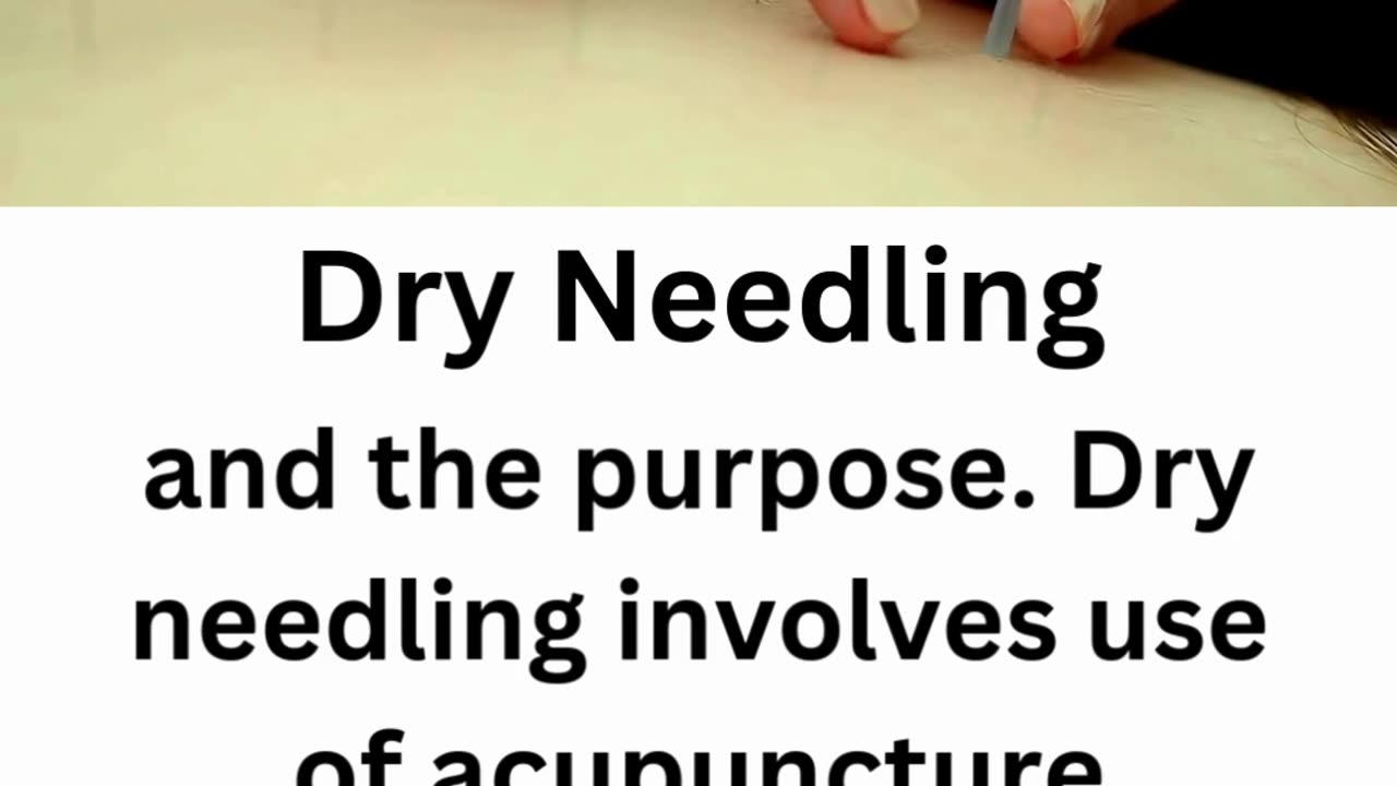 Dry Needling Treatment | Divinecare Physiotherapy Langley BC