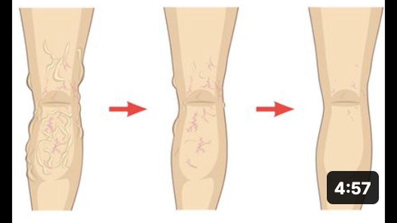 "Natural Methods for Eliminating Varicose Veins"