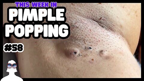 This Week In PIMPLE POPPING #58