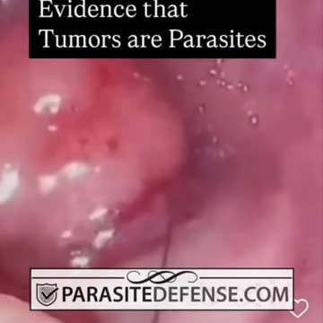 ⚠️More footage of what is in "Cancer Tumor’s."