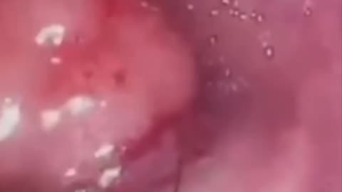 ⚠️More footage of what is in "Cancer Tumor’s."