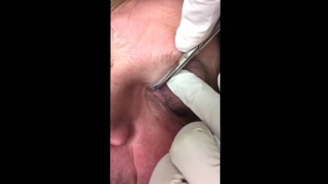 Milia removal on the upper eyelid For medical education NSFE