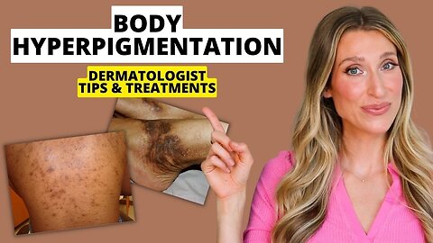 Dermatologist Explains Body Hyperpigmentation: What Causes It, Best Treatments, Prevention, & More!