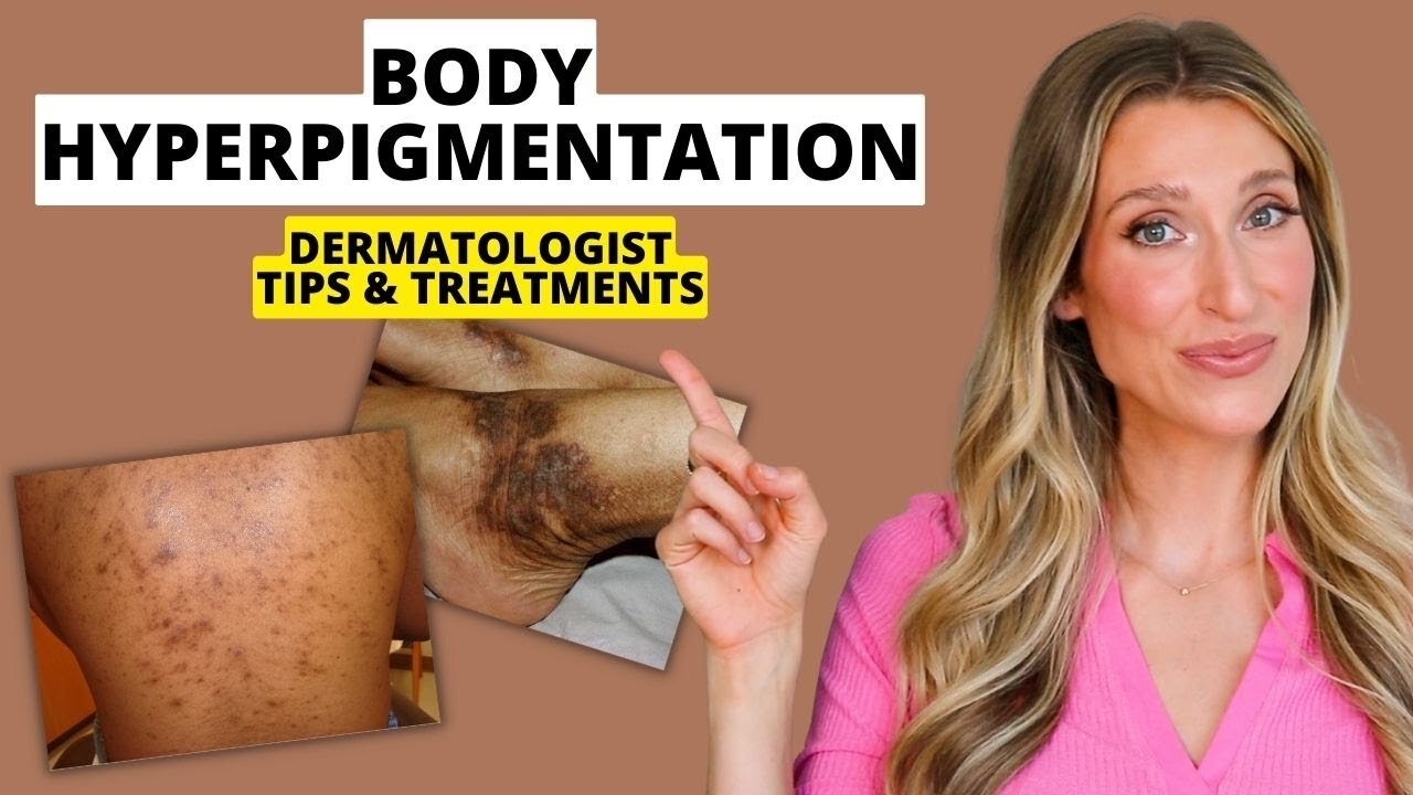 Dermatologist Explains Body Hyperpigmentation: What Causes It, Best Treatments, Prevention, & More!