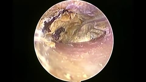 The Itching Stopped after Removing Ear Dead Skin