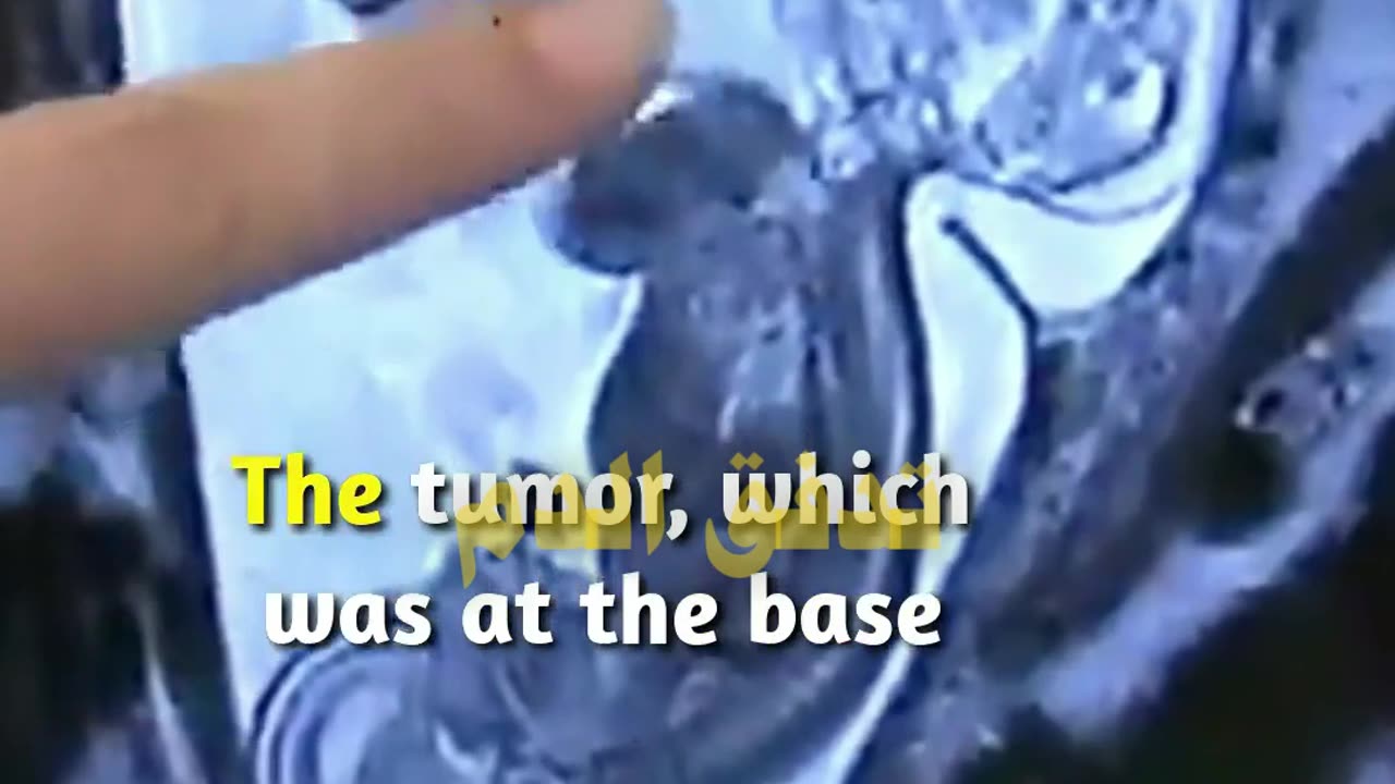 الطفلة المعجزة..اتولدت مرتين ونجت من ورم نادر| الساينتست - El Scientist