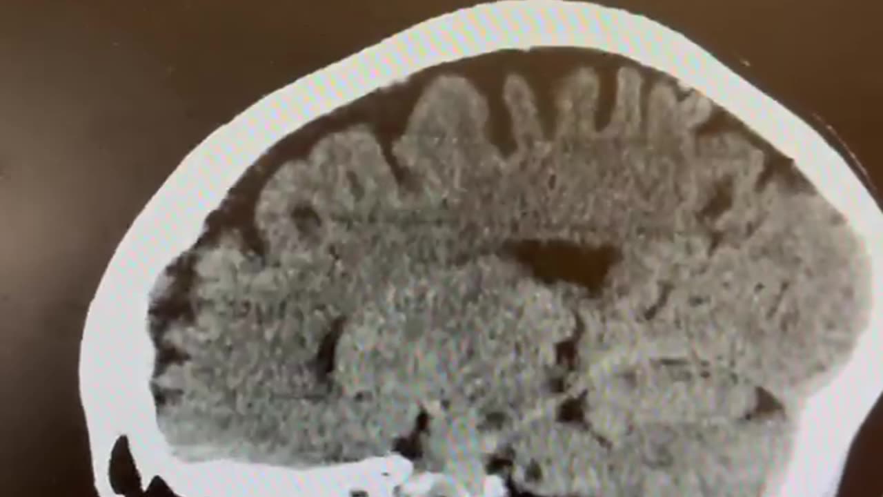 emical lobotomy in a five times jabbed patient.