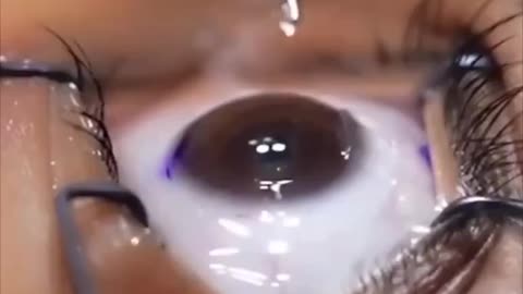 Impressive precision of an eye surgeon performing LASIK surgery