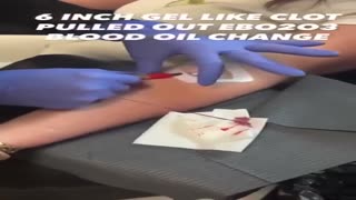 Live Patient Getting Blood Removed As They Watch A Long Stringy Clot Comes Out...