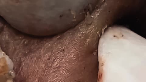 New satisfying blackhead removal #9