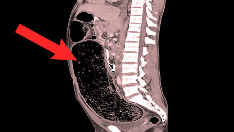 A Lawyer Couldn't Sleep For 9 Days. This Is What Happened To Her Colon.