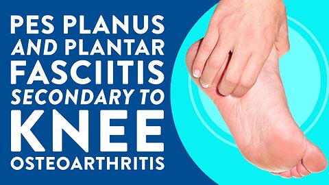 Pes planus and plantar fasciitis secondary to knee osteoarthritis