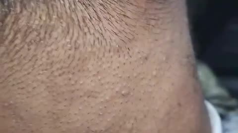 In Grown Hair