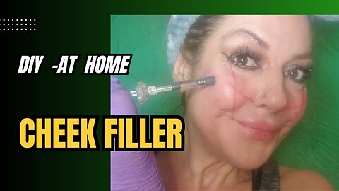 DIY AT-HOME CHEEK FILLER -code MANDA 15% off @ Meamoshop