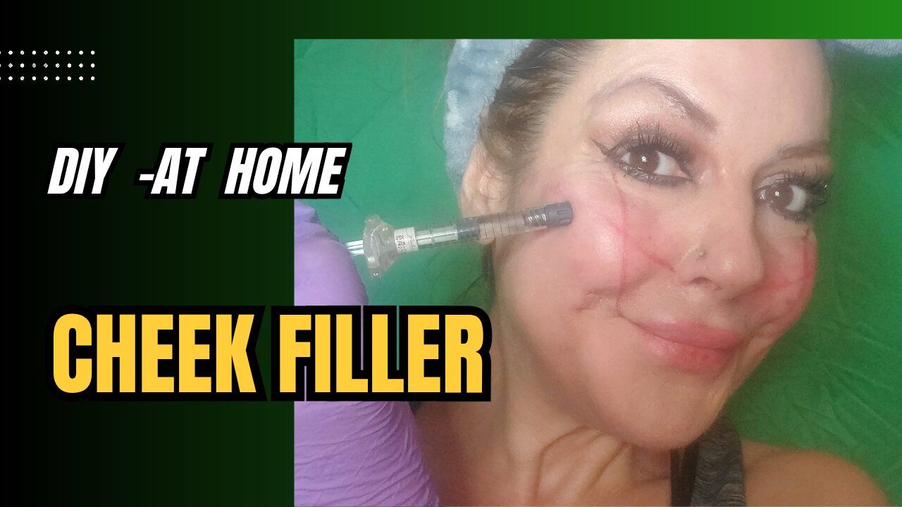 DIY AT-HOME CHEEK FILLER -code MANDA 15% off @ Meamoshop
