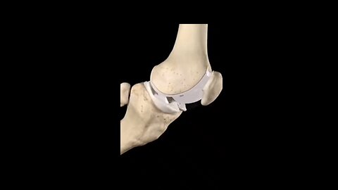 Total knee replacement #Bones#BoneHealth#BoneCare#StrongBones#BoneStrength#BoneHealing#BoneInjury