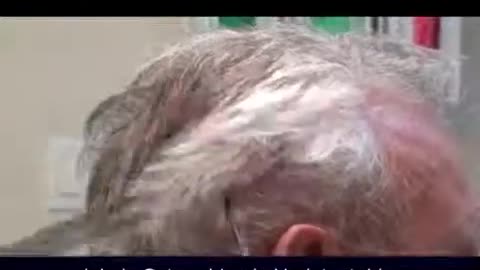 Dr. Brett Bolton – Amazing Hair Transplant Results, Another Happy Patient!