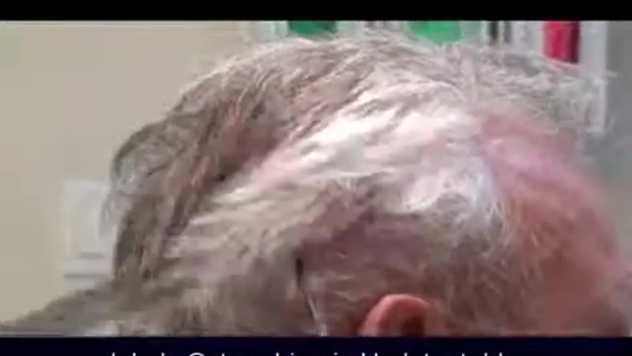 Dr. Brett Bolton – Amazing Hair Transplant Results, Another Happy Patient!