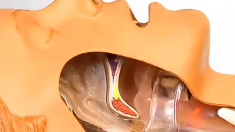 Airway Insertion Procedure Explained, Life-Saving Medical Skill