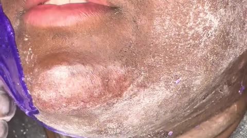 Full Face Waxing with Sexy Smooth Hypnotic Purple Seduction Hard Wax | @fountainofskn