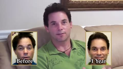 Dr. Brett Bolton: Natural-Looking Hair Transplant Results