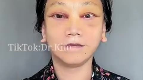 🤯✨ You Won't Believe the Stunning Before & After of Anti-Aging Face Surgery! | FunFM