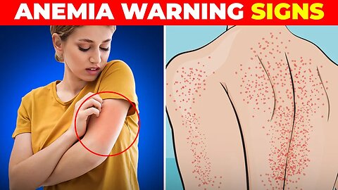 Warning Signs of Anemia & Low Platelets You Should Never Ignore